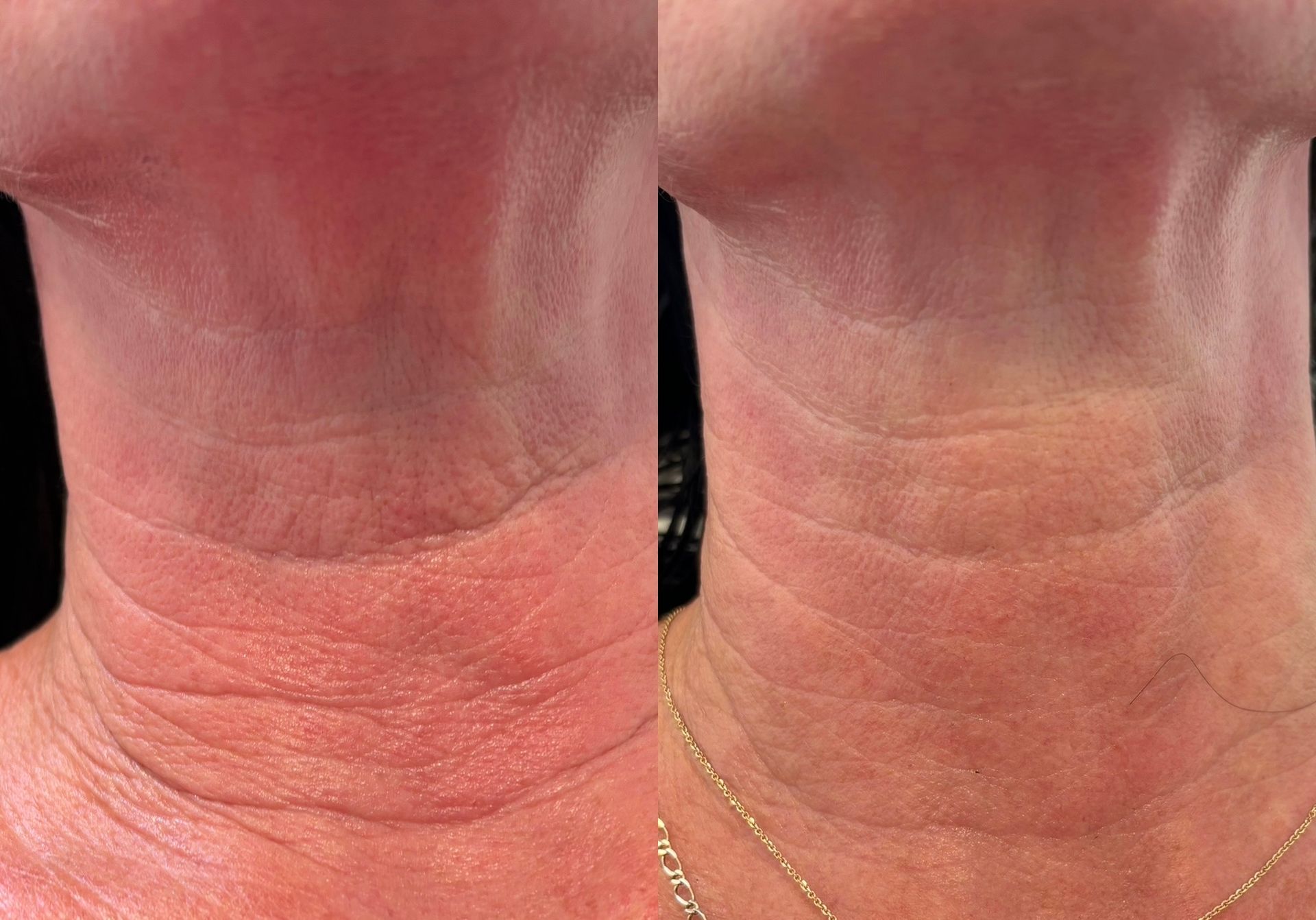A before and after photo of a woman 's neck and neckline.