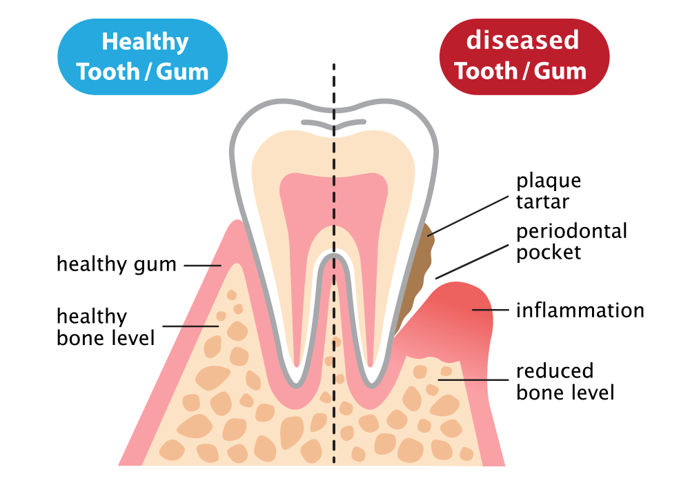 A diagram of a healthy tooth and a diseased tooth/gum.