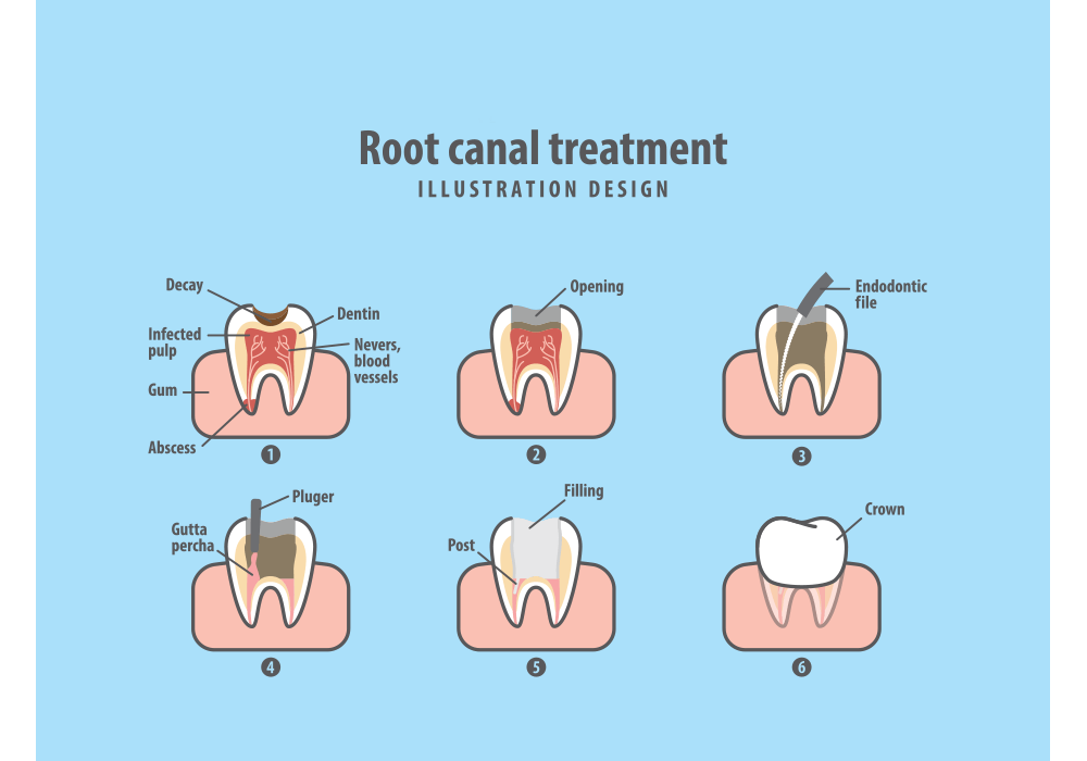 A diagram showing the process of root canal treatment.