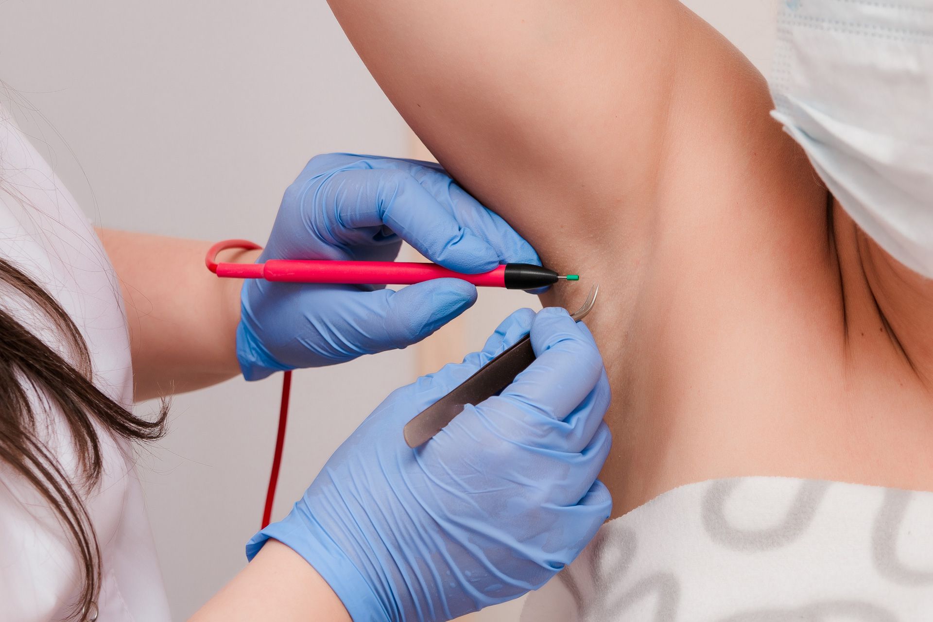 A woman is getting an electrolysis treatment on her armpit.