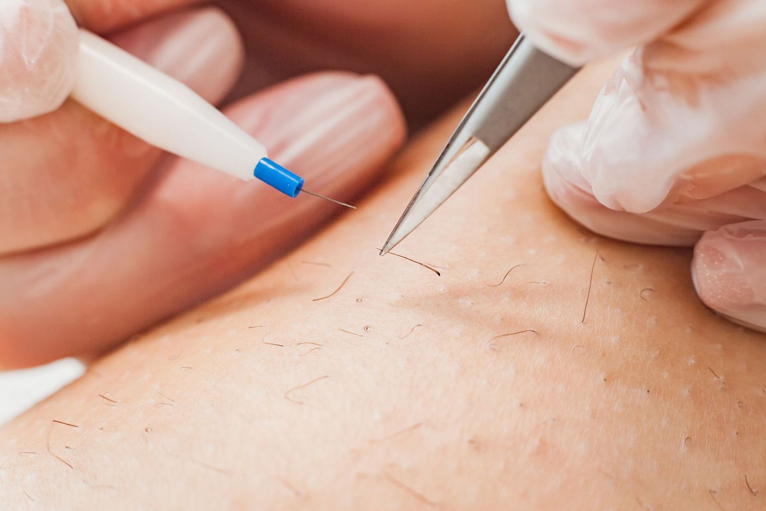 A person is using tweezers to remove hair from a person 's leg.