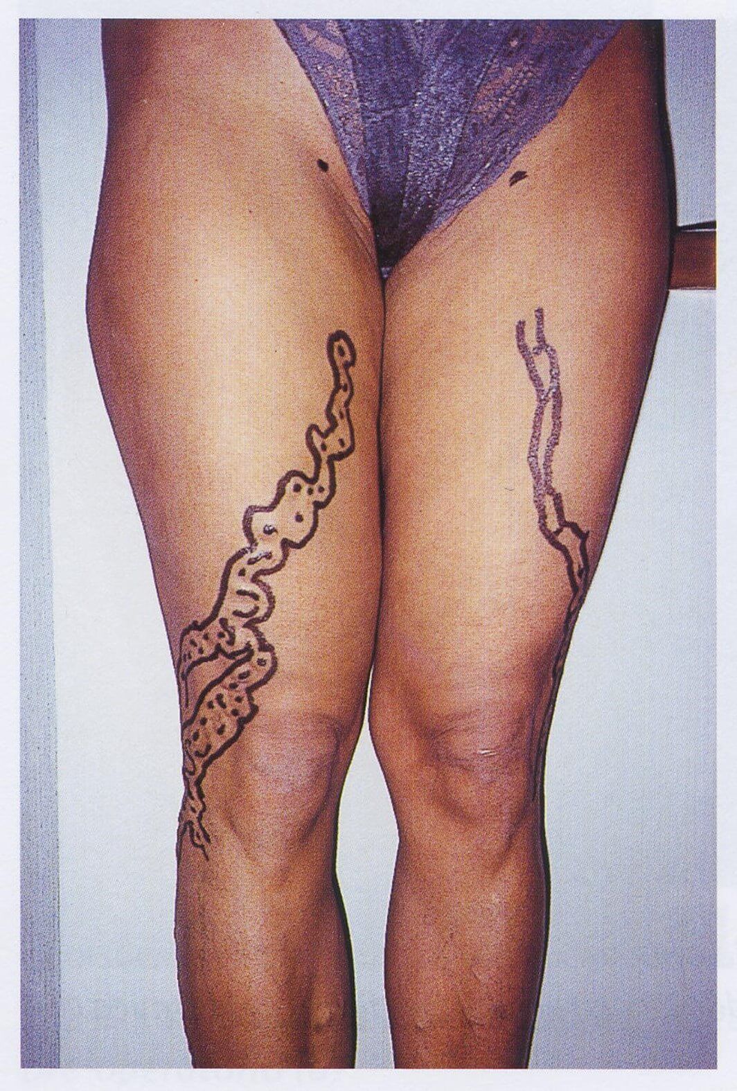 Varici da reflusso iuxta-safenico