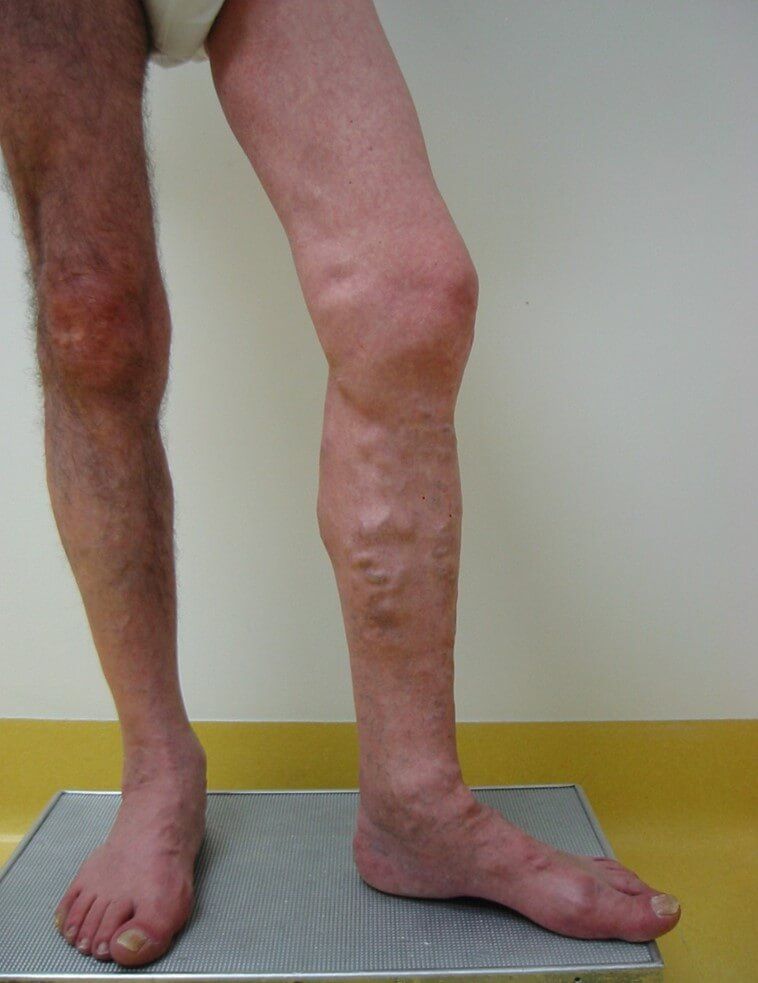 Varici totalmente correlabili al reflusso safenico lungo