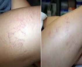 scleroterapia prima e dopo