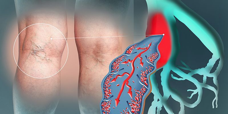 illustrazione schematica varice arto inferiore