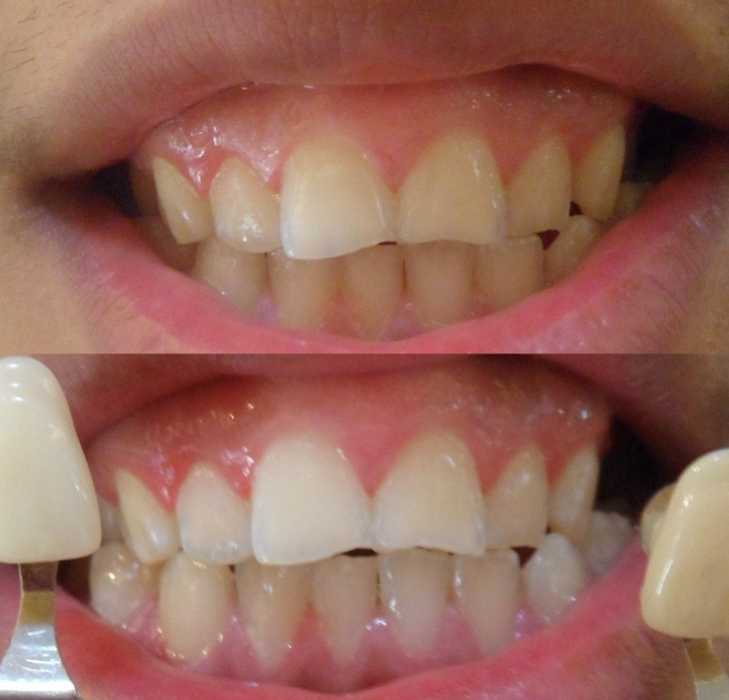 Close-up of teeth before and after cosmetic dental work, showing whiter, straighter smile.