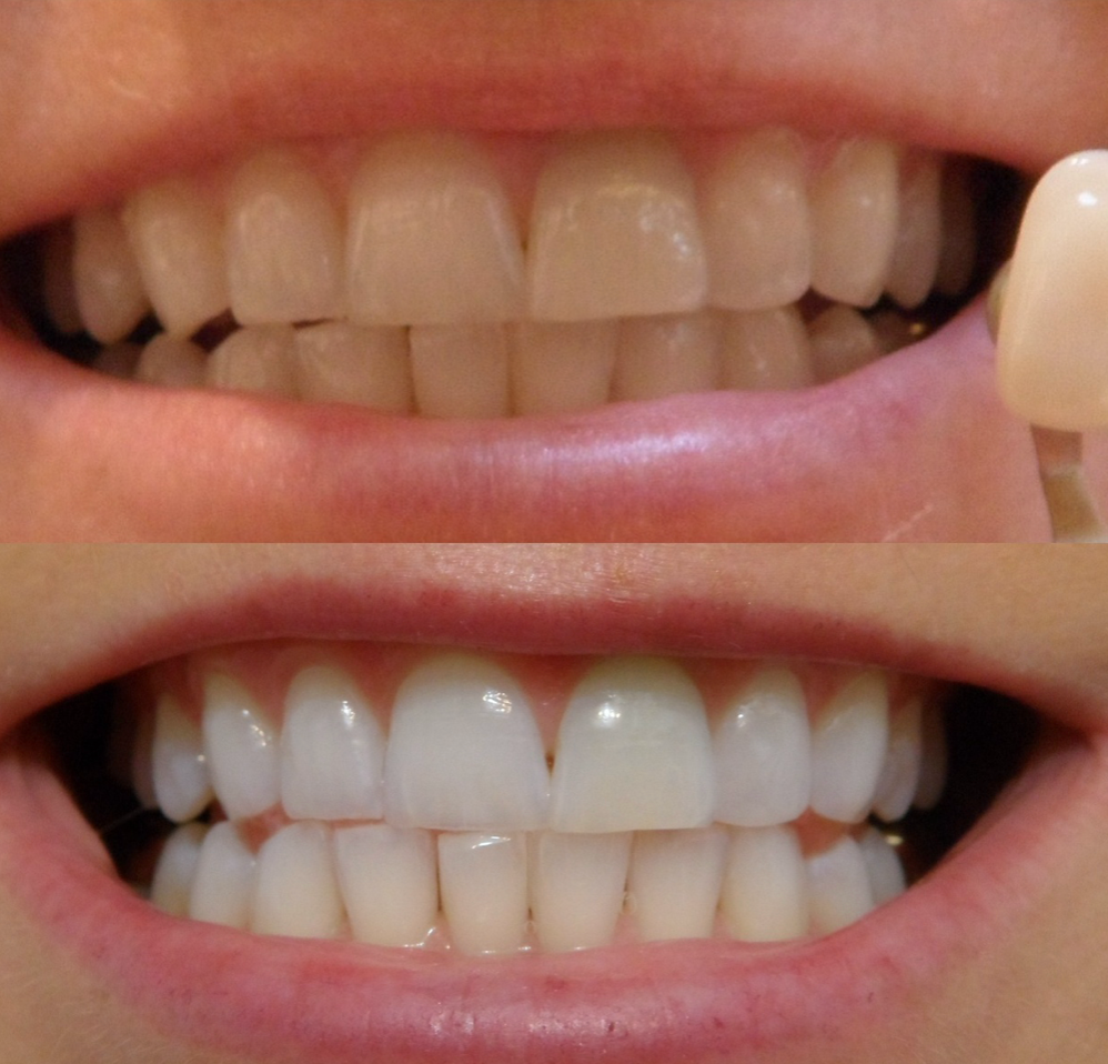 Side-by-side comparison of before and after teeth whitening, showing a brighter smile.