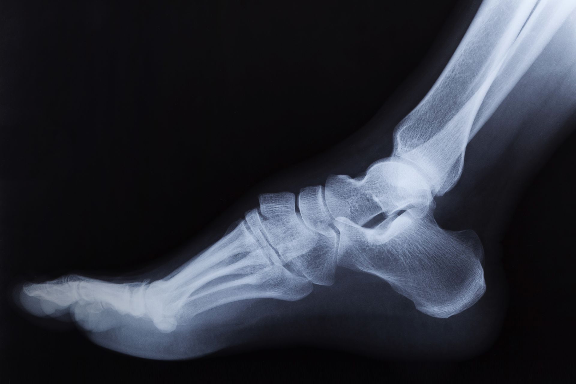 X-ray of a human foot, showing bones in a side view.