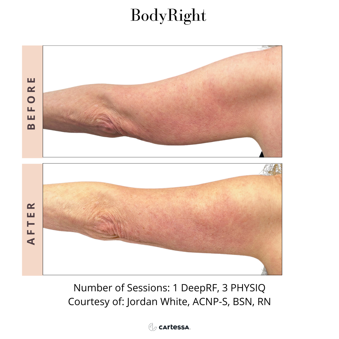 Comparison of a before-and-after photo showing an arm with reduced skin laxity after body contouring treatment.