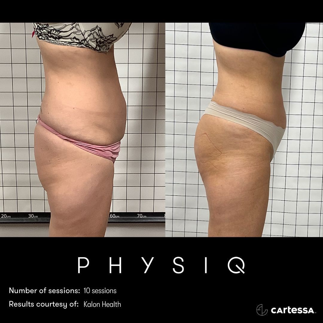 Side-by-side photos of a person's torso. Before and after treatment for body contouring.