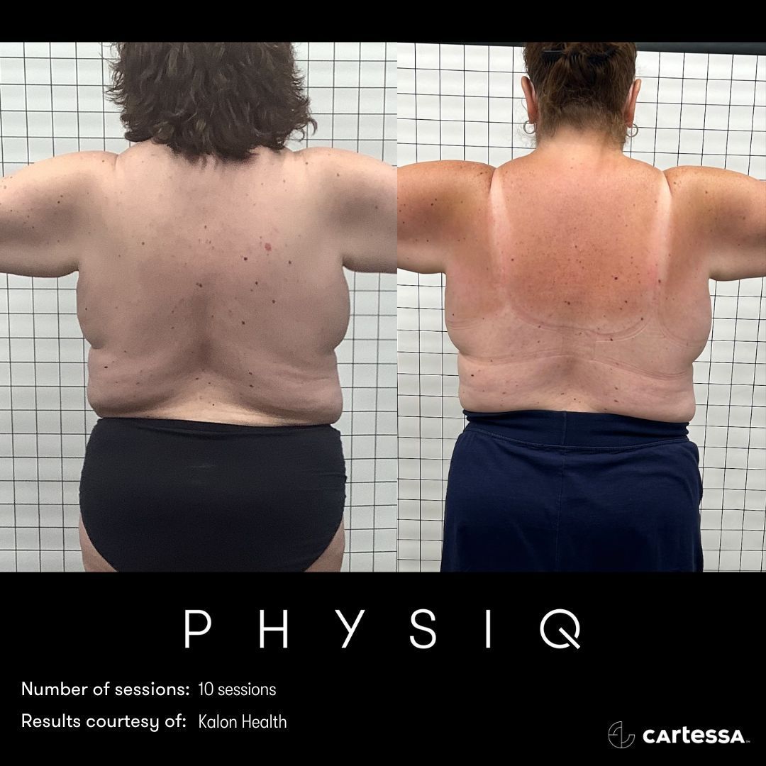 Comparison of back view before and after Physique treatment. Body fat reduction visible.