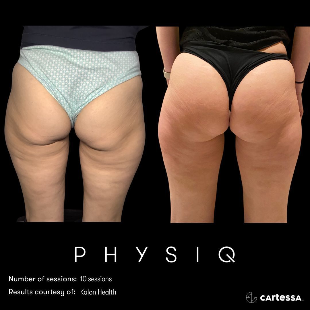 Side-by-side comparison of buttocks and thighs. Before and after images showing cellulite reduction after Physiq treatments.
