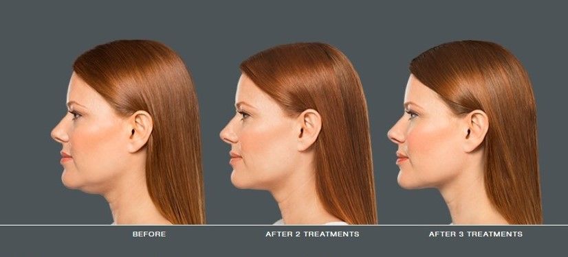 Side-profile comparison of a woman's face before and after cosmetic treatments, showing improvement in neck and jawline. Side-profile comparison of a woman's face before and after cosmetic treatments, showing improvement in neck and jawline.