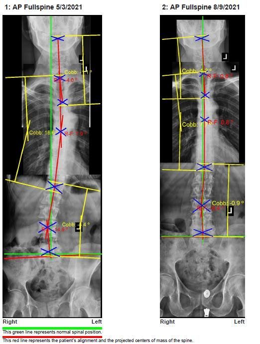 Chiropractic Biophysics — Hollywood Blvd, FL — Integrity Chiropractic