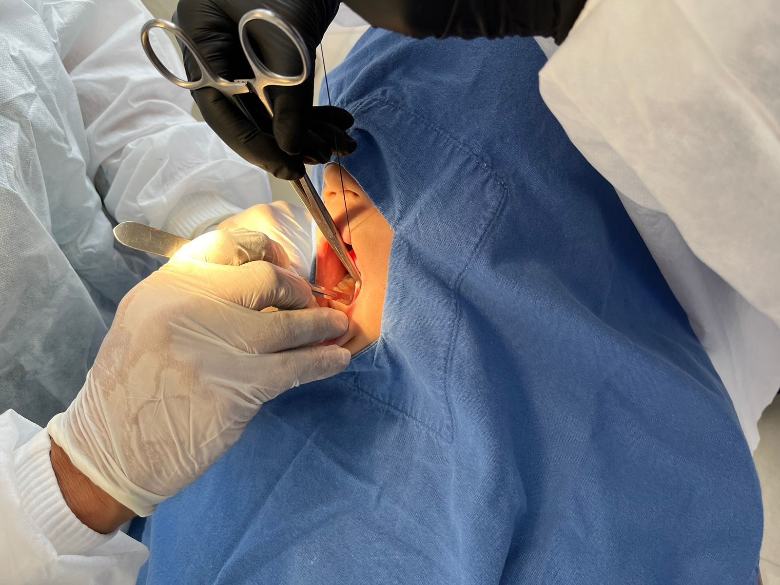 Manos con guantes quirúrgicos utilizando instrumentos en un paciente cubierto con paños azules durante un procedimiento.