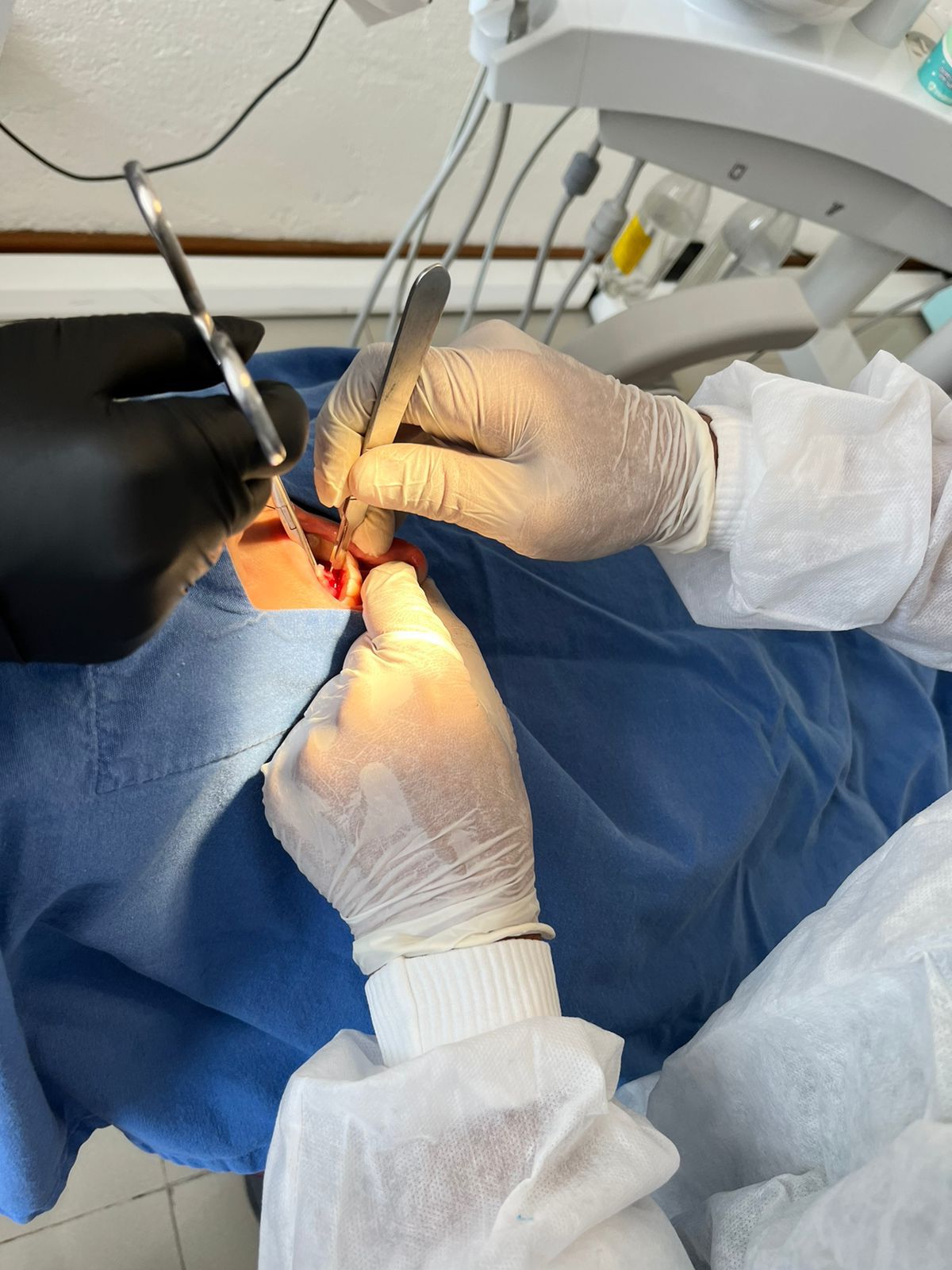 Dentista realizando un procedimiento dental. Manos enguantadas utilizando herramientas dentro de la boca abierta del paciente. Paño azul.