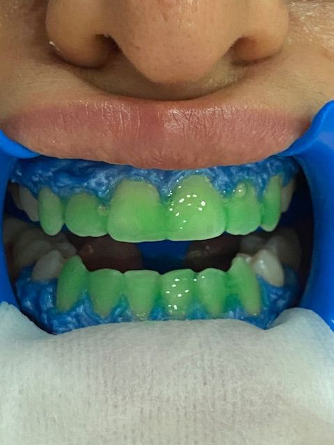 Dientes cubiertos de gel verde, con retractor bucal azul. Tejido blanco debajo del labio inferior.