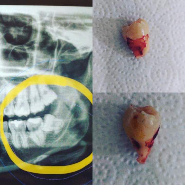 Radiografía de dientes con muela del juicio resaltada; extracción de muela con sangre roja.