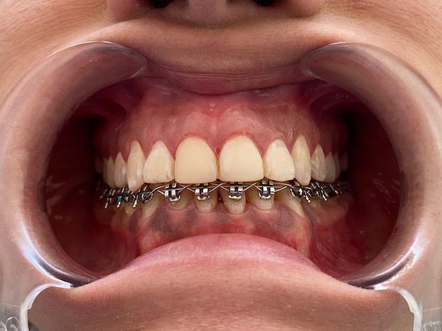Boca con brackets, mantenida abierta por un retractor. Se ven los dientes, con brackets metálicos y alambres.