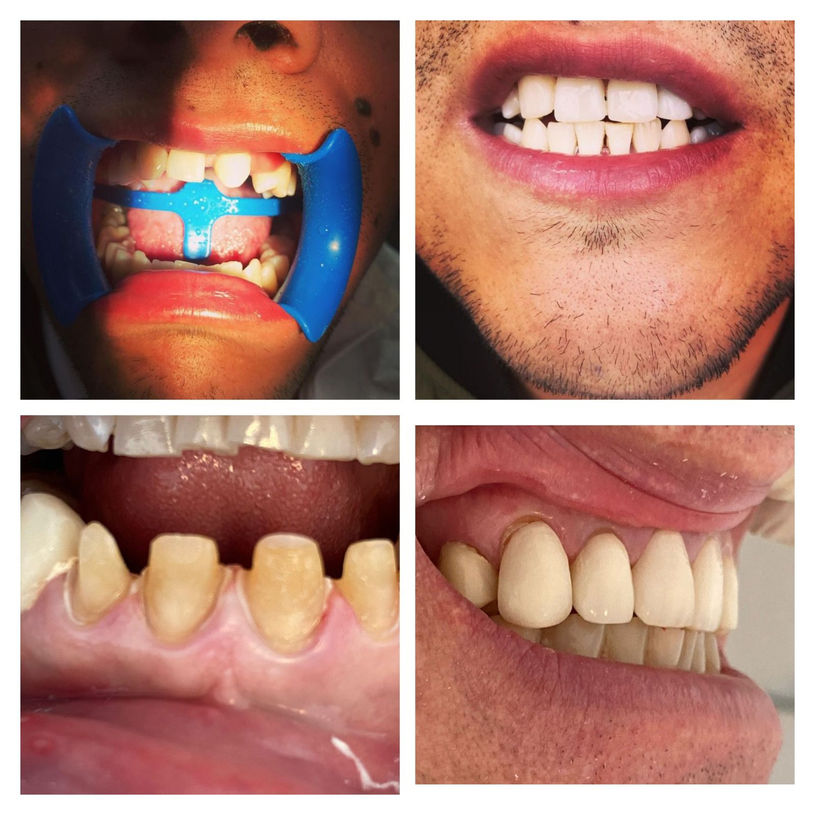 Cuatro imágenes que muestran trabajos dentales. Incluye fotos del antes y el después del blanqueamiento dental y la colocación de la corona.