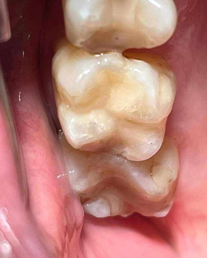 Primer plano de tres dientes; el diente posterior tiene un tinte marrón, lo que sugiere una posible tinción o caries.