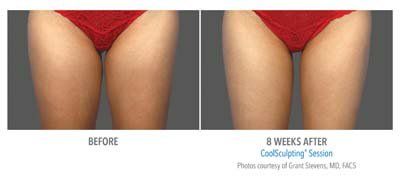 Reduce Unwanted Body Fat with CoolSculpting Treatment in Washington DC