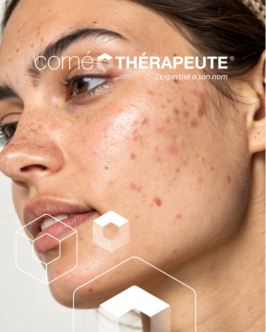 Femme souffrant d'acné, publicité pour un produit. Logo de traitement contre l'acné superposé à l'image.