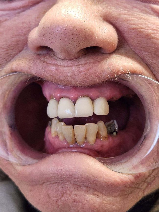 Patient stabili-teeth results before