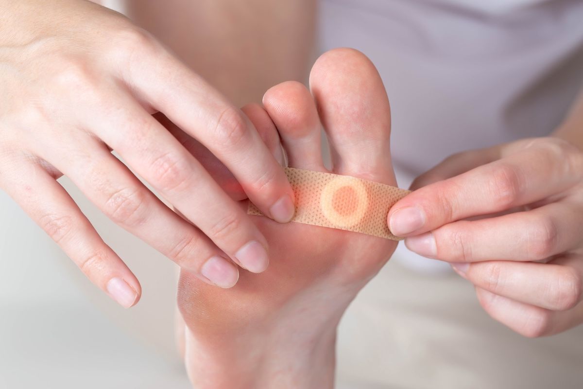 How to identify verrucae