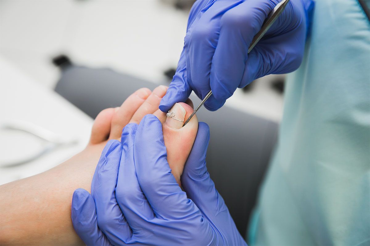Can You Cure an Ingrown Toenail from Home?