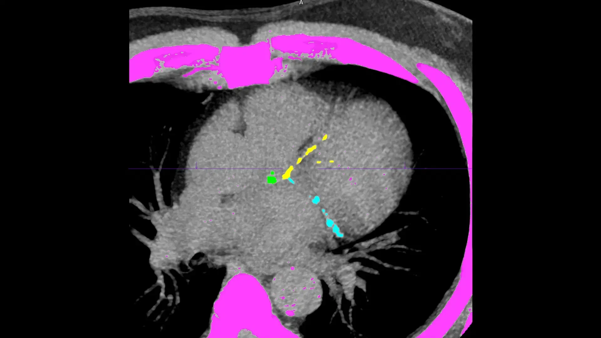 Mobile CT scanner configured for cardiac imaging studies