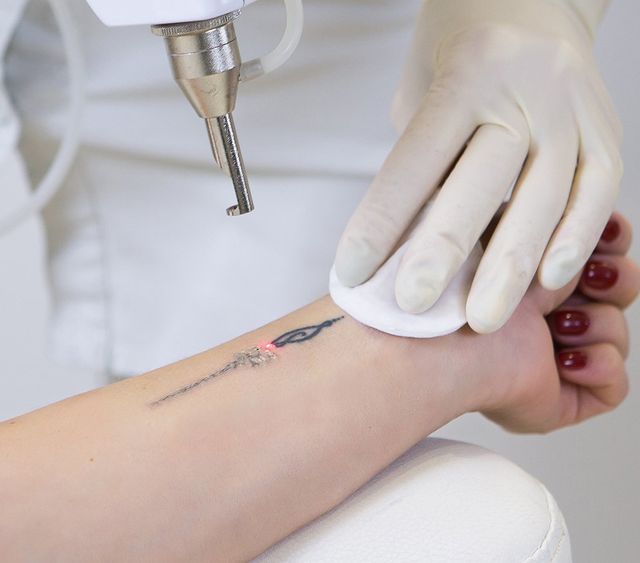 Tattoo Removal Houston | Laser Therapy Tattoo Removal