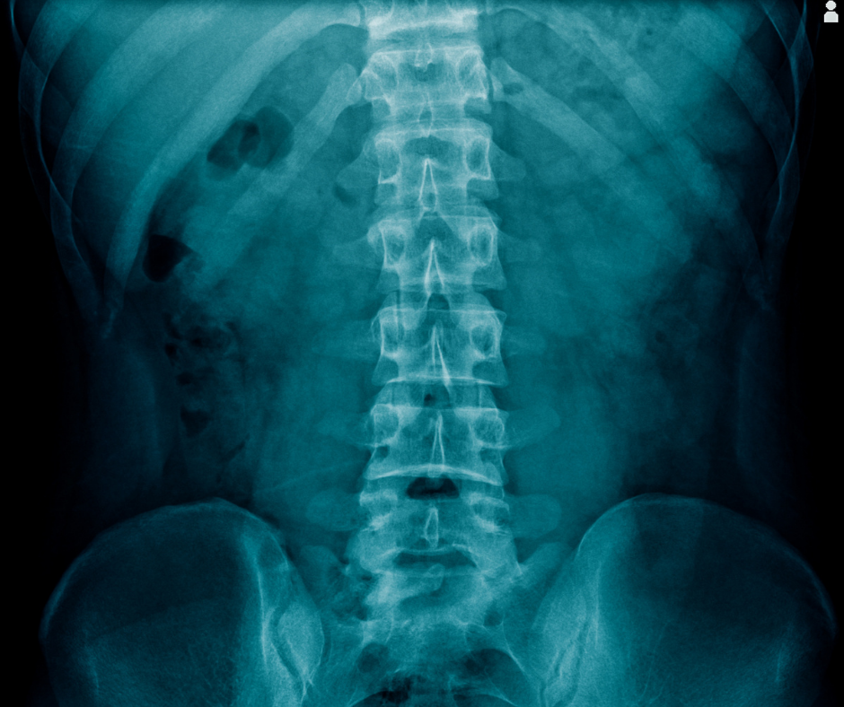 X-ray of human spine, showing lumbar vertebrae, ribs, and pelvis.