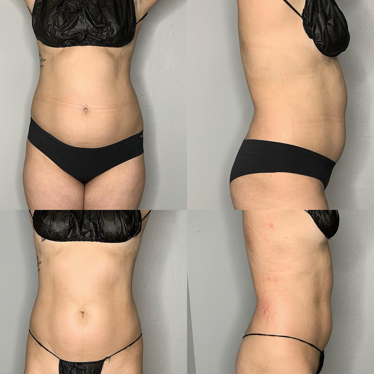 Morpheus8 body contour photo results