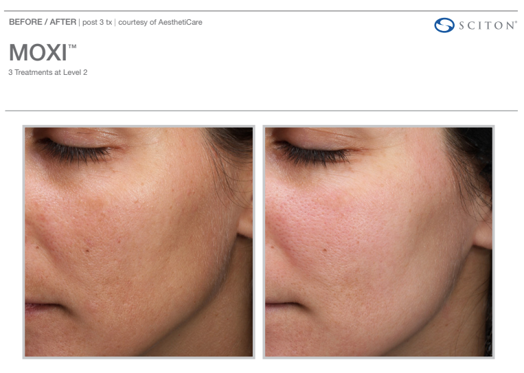 MOXI laser skin resurfacing before and after image
