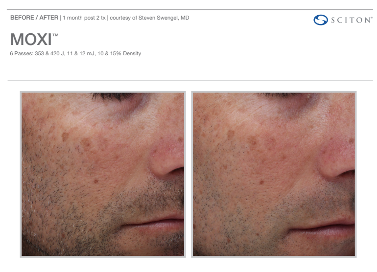 MOXI laser skin resurfacing before and after image