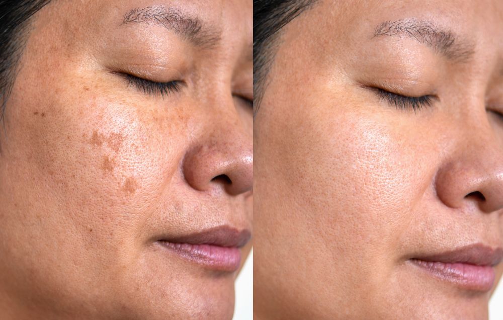 Before and after photos of a woman's face, showing reduction in brown spots and smoother skin.