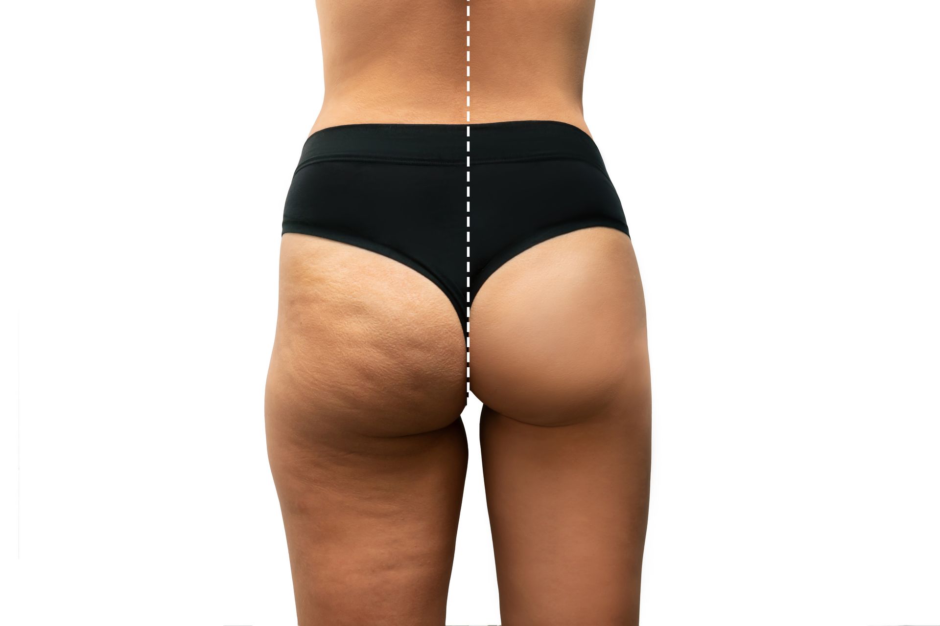 Side-by-side comparison of buttocks: one side shows cellulite, the other is smooth.