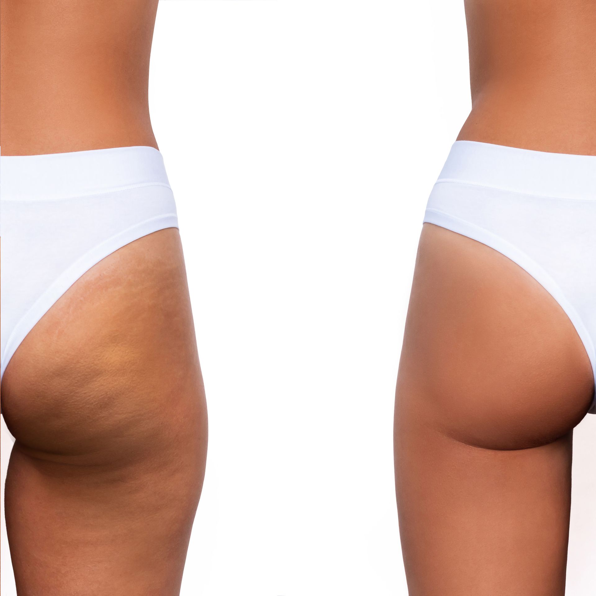 Side-by-side comparison of a buttocks. Left shows cellulite. Right shows smooth skin.