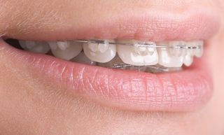 Teeth with Braces — Cosmetic Dentistry in Hemet, CA