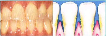 Gum disease explanation — Periodontics in  Hemet, CA