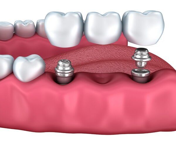3d lower teeth and dental implant  - Dental Care Services in Hemet, CA