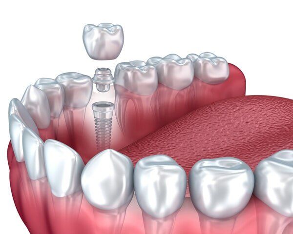 3d lower tooth and dental implant  - Dental Care Services in Hemet, CA