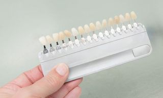 Check Veneer of Tooth Crown  — Cosmetic Dentistry in Hemet, CA