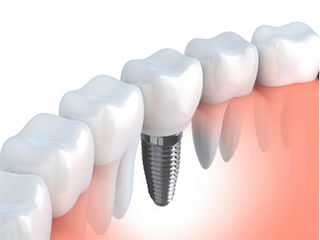 Replacing a missing tooth — Periodontics in  Hemet, CA