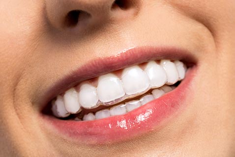 Smiling Girl Wearing Invisible Teeth Braces — Orthodontist in Hemet, CA