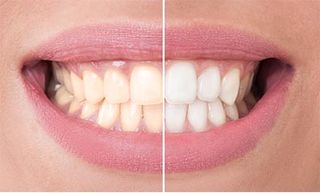 Teeth Whitening — Cosmetic Dentistry in Hemet, CA