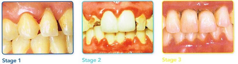 Gum disease picture — Periodontics in  Hemet, CA