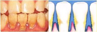 Advance Gum disease picture — Periodontics in  Hemet, CA