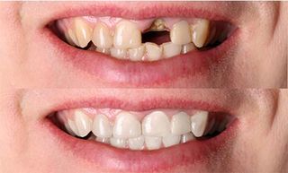 Tooth Restoration — Cosmetic Dentistry in Hemet, CA